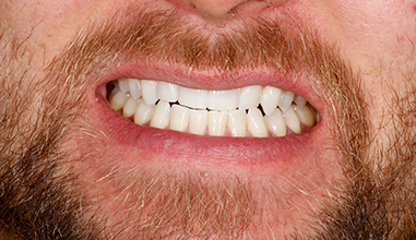 After - Natural Smiles Implant & Cosmetic Dentistry
