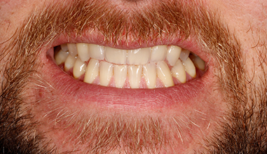 Before - Natural Smiles Implant & Cosmetic Dentistry