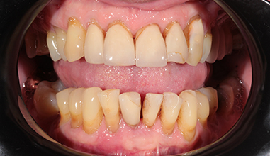 Before - Natural Smiles Implant & Cosmetic Dentistry