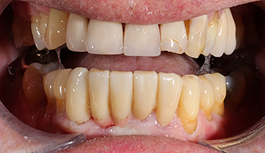 After - Natural Smiles Implant & Cosmetic Dentistry