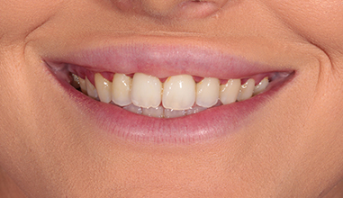 Before - Natural Smiles Implant & Cosmetic Dentistry