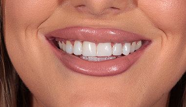 After - Natural Smiles Implant & Cosmetic Dentistry