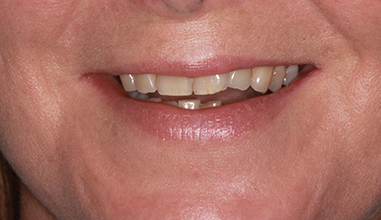 Before - Natural Smiles Implant & Cosmetic Dentistry