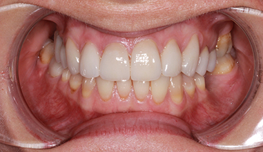 After - Natural Smiles Implant & Cosmetic Dentistry
