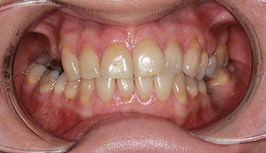Before - Natural Smiles Implant & Cosmetic Dentistry