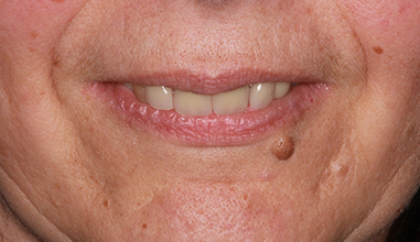After - Natural Smiles Implant & Cosmetic Dentistry