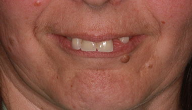 Before - Natural Smiles Implant & Cosmetic Dentistry