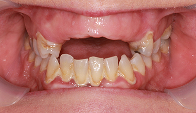 Before - Natural Smiles Implant & Cosmetic Dentistry