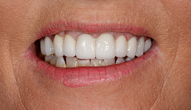 After - Natural Smiles Implant & Cosmetic Dentistry