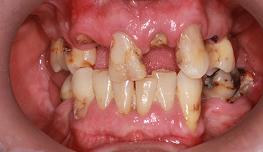 Before - Natural Smiles Implant & Cosmetic Dentistry
