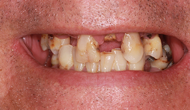Before - Natural Smiles Implant & Cosmetic Dentistry