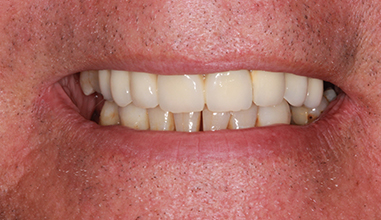 After - Natural Smiles Implant & Cosmetic Dentistry