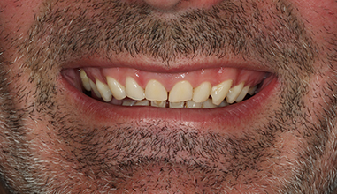 Before - Natural Smiles Implant & Cosmetic Dentistry