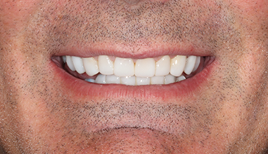After - Natural Smiles Implant & Cosmetic Dentistry