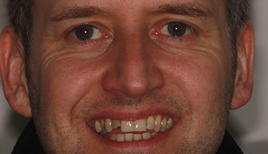 Before - Natural Smiles Implant & Cosmetic Dentistry