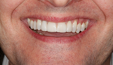 After - Natural Smiles Implant & Cosmetic Dentistry