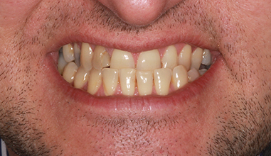 Before - Natural Smiles Implant & Cosmetic Dentistry
