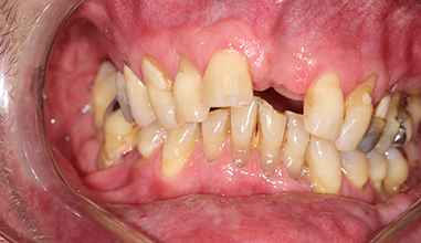 Before - Natural Smiles Implant & Cosmetic Dentistry