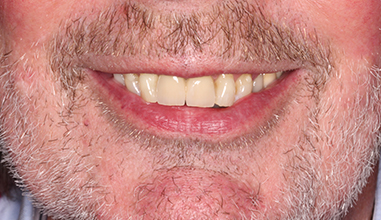 After - Natural Smiles Implant & Cosmetic Dentistry