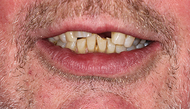 Before - Natural Smiles Implant & Cosmetic Dentistry