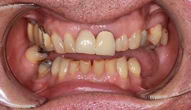 Before - Natural Smiles Implant & Cosmetic Dentistry