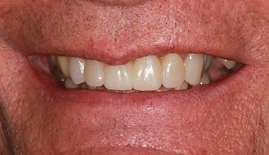 After - Natural Smiles Implant & Cosmetic Dentistry