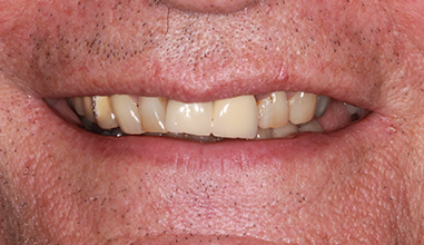 Before - Natural Smiles Implant & Cosmetic Dentistry