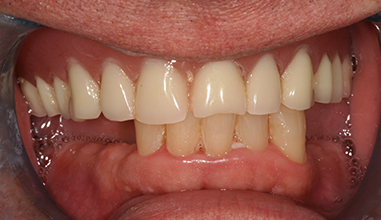 Before - Natural Smiles Implant & Cosmetic Dentistry