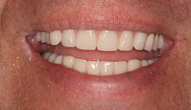 After - Natural Smiles Implant & Cosmetic Dentistry