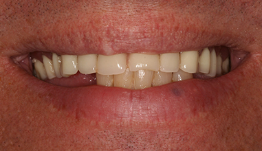 Before - Natural Smiles Implant & Cosmetic Dentistry