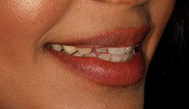 Before - Natural Smiles Implant & Cosmetic Dentistry
