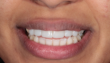 After - Natural Smiles Implant & Cosmetic Dentistry