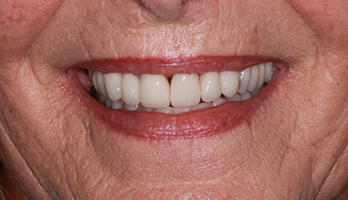 After - Natural Smiles Implant & Cosmetic Dentistry