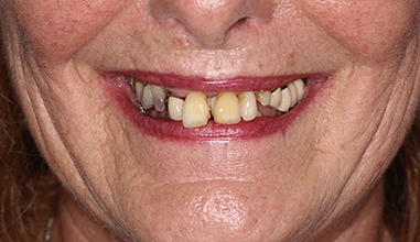 Before - Natural Smiles Implant & Cosmetic Dentistry
