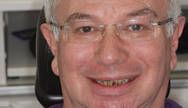 Before - Natural Smiles Implant & Cosmetic Dentistry