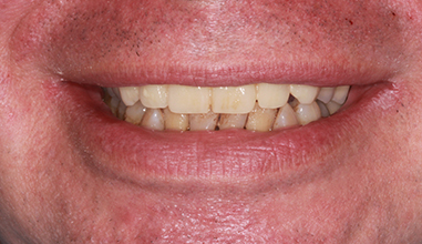 After - Natural Smiles Implant & Cosmetic Dentistry