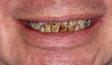 Before - Natural Smiles Implant & Cosmetic Dentistry