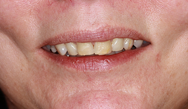 Before - Natural Smiles Implant & Cosmetic Dentistry