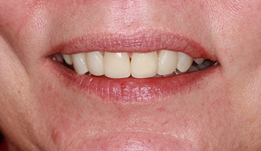 After - Natural Smiles Implant & Cosmetic Dentistry