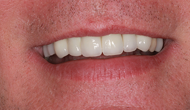 After - Natural Smiles Implant & Cosmetic Dentistry