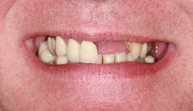 Before - Natural Smiles Implant & Cosmetic Dentistry