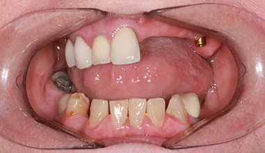 Before - Natural Smiles Implant & Cosmetic Dentistry