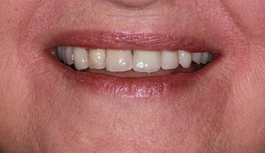 After - Natural Smiles Implant & Cosmetic Dentistry