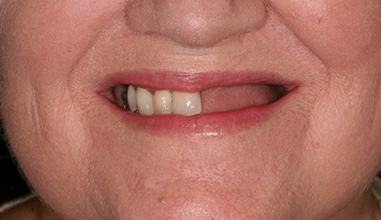 Before - Natural Smiles Implant & Cosmetic Dentistry
