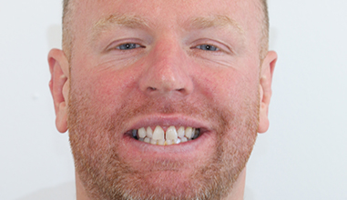 Before - Natural Smiles Implant & Cosmetic Dentistry