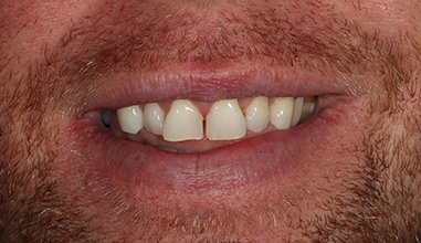 Before - Natural Smiles Implant & Cosmetic Dentistry