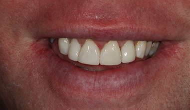 After - Natural Smiles Implant & Cosmetic Dentistry