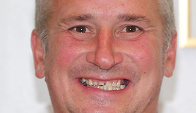 Before - Natural Smiles Implant & Cosmetic Dentistry