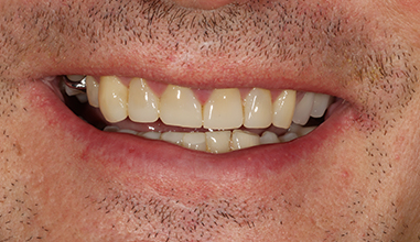 After - Natural Smiles Implant & Cosmetic Dentistry