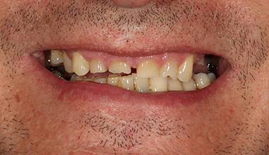 Before - Natural Smiles Implant & Cosmetic Dentistry